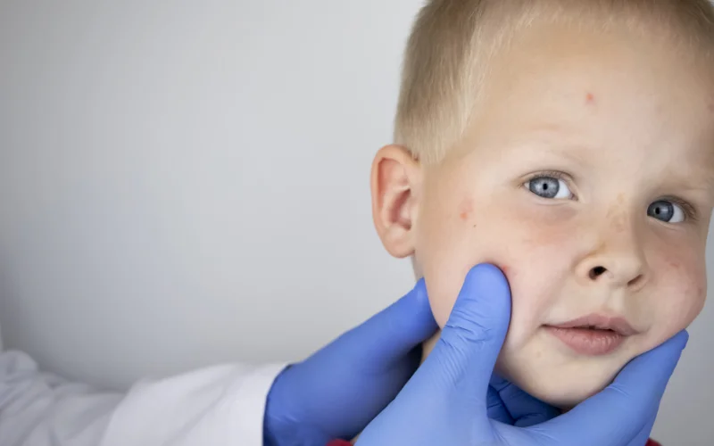 Dermatologia – Pediatria Dermatologia – Pediatria Elisete Crocco