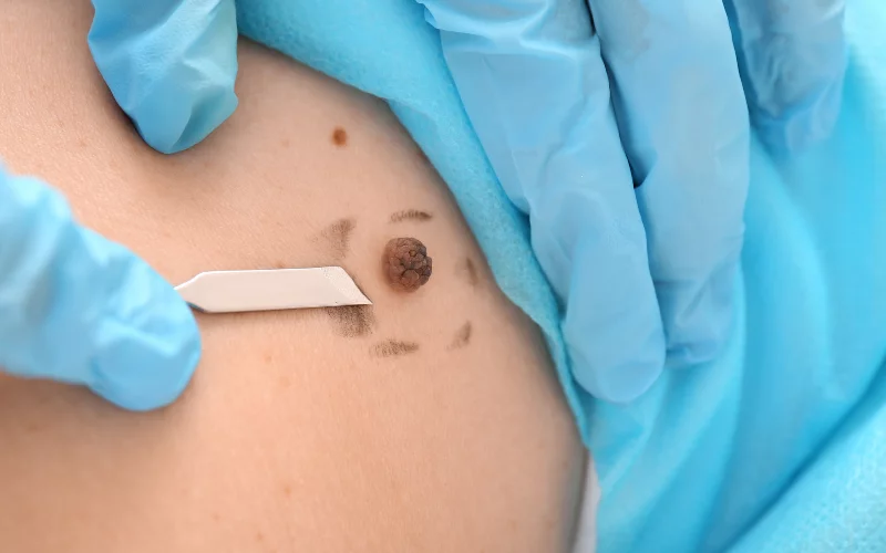 Dermatologia – Cirurgia Dermatologia – Cirurgia Elisete Crocco